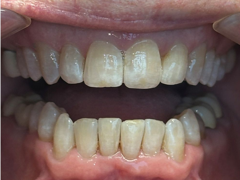 Close-up of a person's open mouth showing upper and lower teeth, with visible gaps and slightly uneven tooth alignment—perfect for showcasing Invisalign before and after photos in Spring Branch TX.