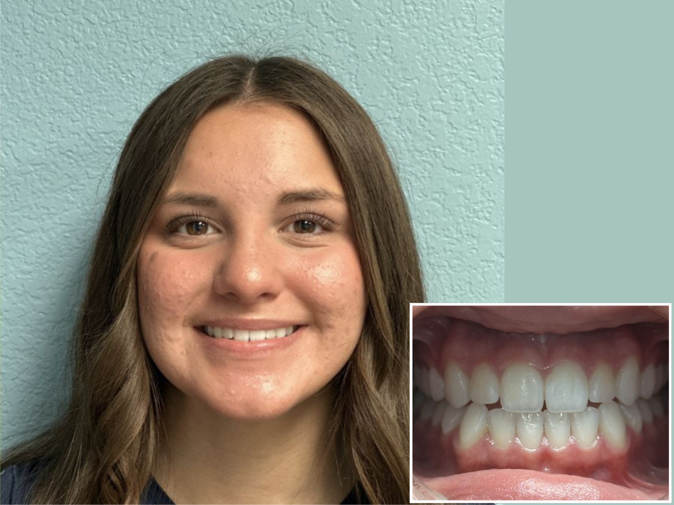 A young woman with long brown hair smiles at the camera in Spring Branch TX; an inset shows a close-up of her straight teeth and gums, highlighting stunning Invisalign before and after photos.