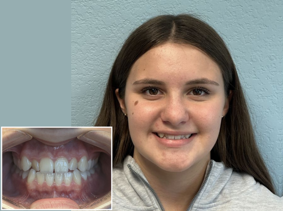 Teenage girl with straight brown hair smiling in front of a light blue wall; inset shows a close-up of her teeth and gums with slight dental crowding—an ideal candidate for Invisalign in Spring Branch TX.