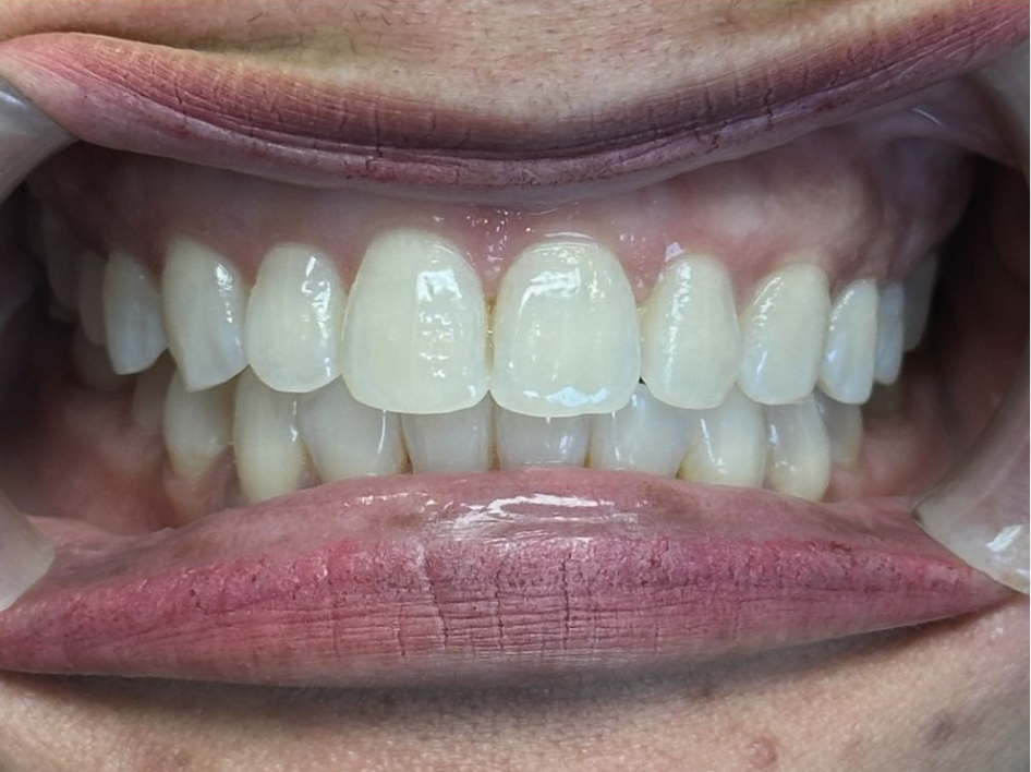 A close-up of a person's mouth showing both upper and lower teeth with gums visible and lips held open, perfect for showcasing Invisalign before and after photos in Spring Branch TX.