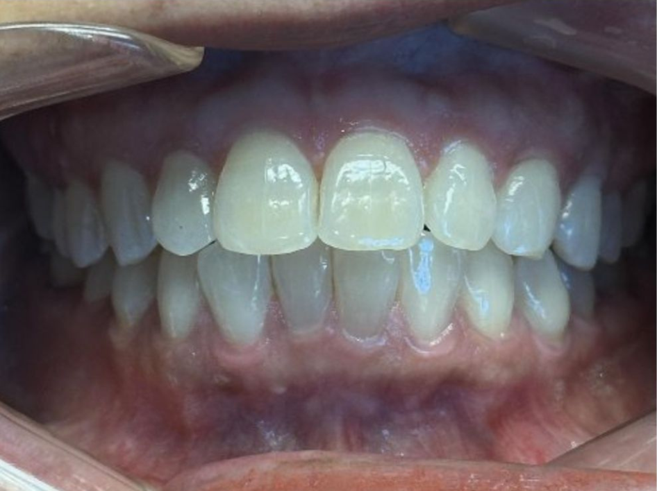 Close-up of a person's mouth showing upper and lower teeth with a slightly uneven alignment and healthy gums, lips held open with a dental retractor—ideal for Invisalign before and after photos in Spring Branch TX.