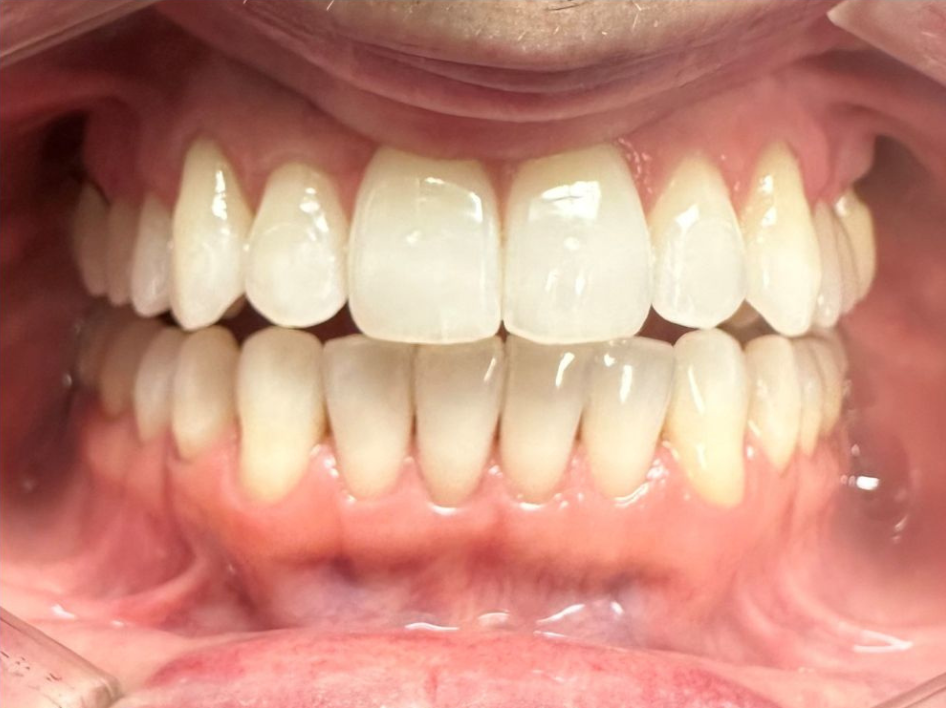 A close-up view of a person's mouth open wide, showing clean, aligned upper and lower teeth and healthy gums—perfect for showcasing Invisalign before and after photos in Spring Branch TX.