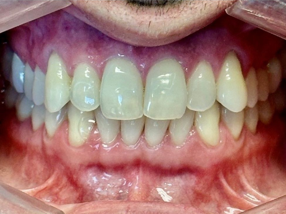 Close-up view of a person's open mouth showing upper and lower teeth and gums with dental cheek retractors in use, ideal for capturing Invisalign before and after photos at our Spring Branch TX location.
