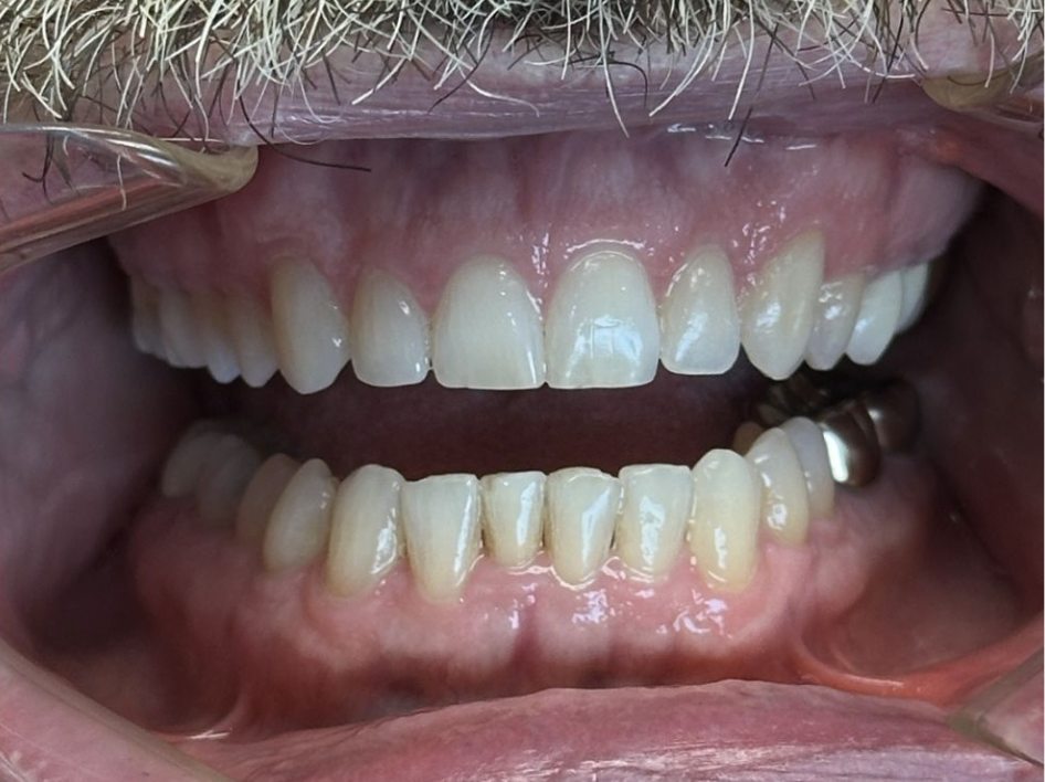 Close-up of an open mouth showing upper and lower teeth, with a visible dental crown on a lower molar and some dental plaque—ideal for Before and After Photos at a Spring Branch TX Invisalign consultation.