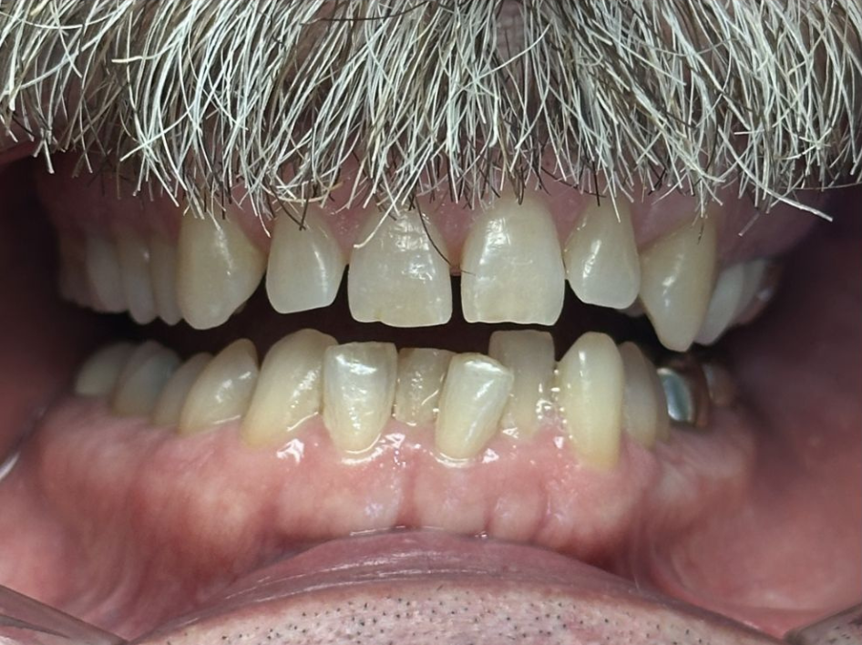 Close-up of a person's mouth with lips parted, showing upper and lower teeth with visible gaps and misalignment, along with a mustache above the top lip—ideal for Invisalign before and after photos in Spring Branch TX.