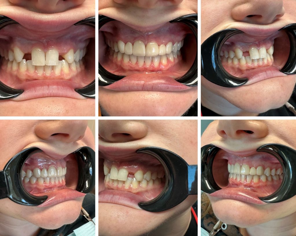 Smile Gallery: A set of six close-up dental photos from Spring Branch TX showcasing before & after teeth alignment, viewed from the front and both sides with cheek retractors in place.